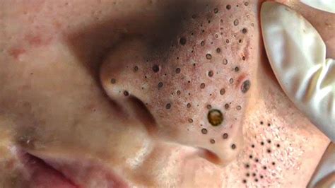 why is blackhead removal satisfying|Why some people find pimple popping so grossly satisfying.